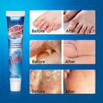 Sumifun - Toe Seam Itching Cream