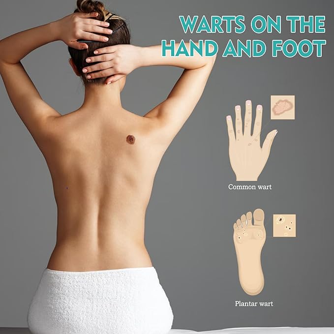 West & Month - Skin Tag Remover