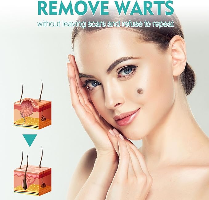 West & Month - Skin Tag Remover